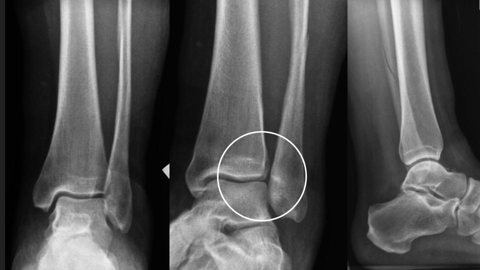 Figure 5 for case syndesmosis ( RID6088 )